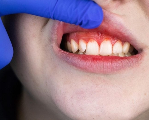 This Common Bacterium Hiding in Your Mouth May Help Trigger Breast Cancer