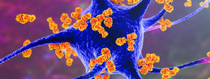 Forever Chemicals Linked to Multiple Sclerosis in Concerning New Study : ScienceAlert