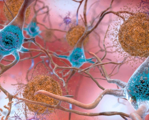 Why people can have Alzheimer’s-related brain damage but no symptoms