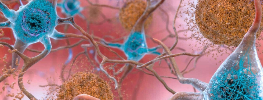 Why people can have Alzheimer’s-related brain damage but no symptoms