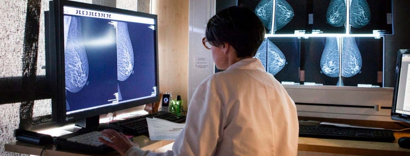 AI-assisted mammograms cut risk of developing aggressive breast cancer