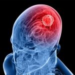 New Molecule Blocks Deadliest Brain Cancer at Its Genetic Root