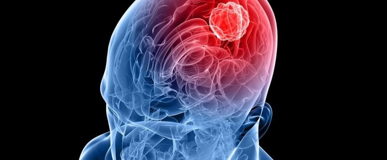 New Molecule Blocks Deadliest Brain Cancer at Its Genetic Root New Molecule Blocks Deadliest Brain Cancer at Its Genetic Root