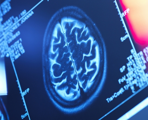 Hidden Patterns of Body Fat Could Be Shrinking Your Brain, Study Finds : ScienceAlert