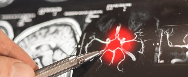 New “Cellular” Target Could Transform How We Treat Alzheimer’s Disease