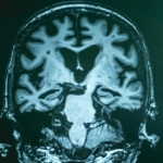 Beyond Amyloid Plaques: Scientists Reveal Broader Chemical Disruptions in Alzheimer’s