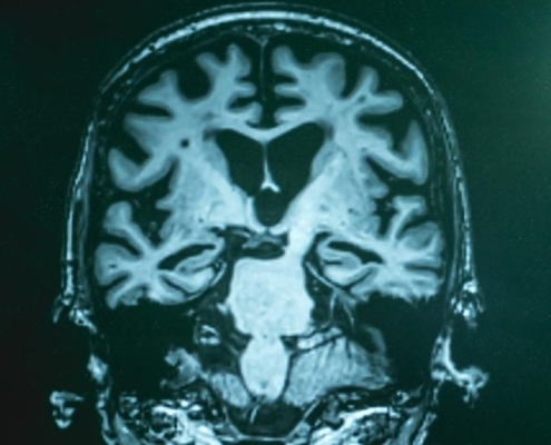 Beyond Amyloid Plaques: Scientists Reveal Broader Chemical Disruptions in Alzheimer’s