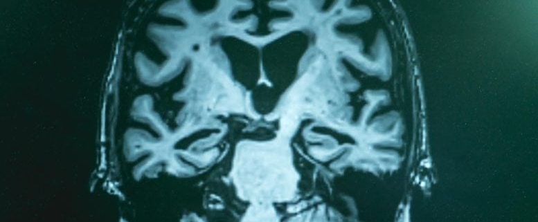 Beyond Amyloid Plaques: Scientists Reveal Broader Chemical Disruptions in Alzheimer’s Beyond Amyloid Plaques: Scientists Reveal Broader Chemical Disruptions in Alzheimer’s