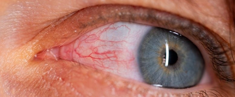 Common Bacteria Found in the Eye Linked to Alzheimer’s Disease Common Bacteria Found in the Eye Linked to Alzheimer’s Disease