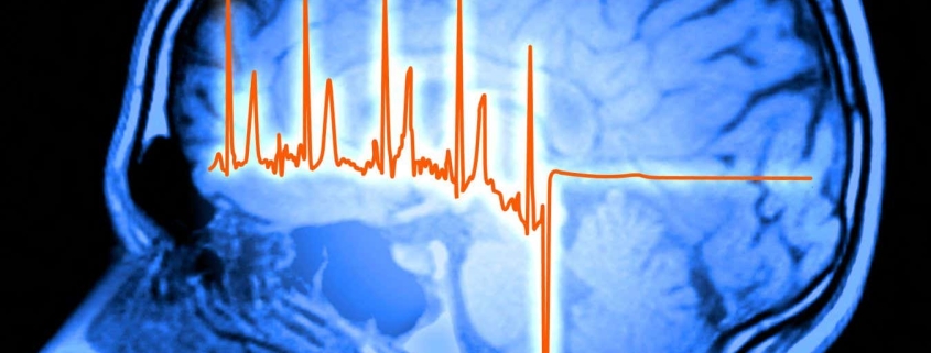 Our brains play a surprising role in recovering from a heart attack