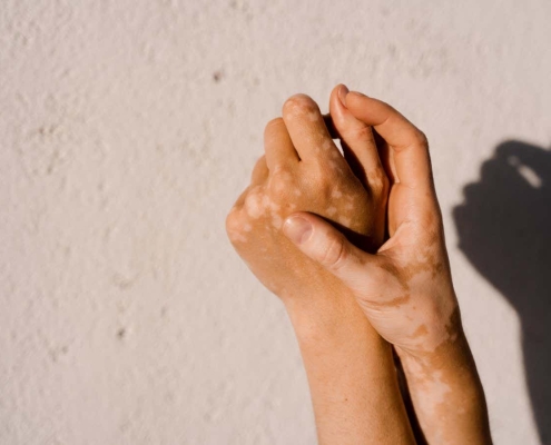 Ruxolitinib: Landmark vitiligo cream targets immune cells that disrupt pigmentation Ruxolitinib: Landmark vitiligo cream targets immune cells that disrupt pigmentation