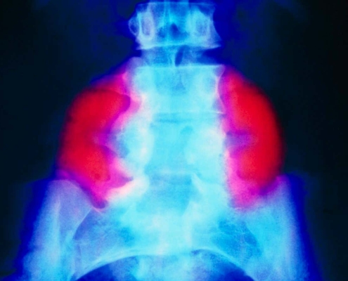 Stem cell patch reverses brain damage in fetuses with spina bifida