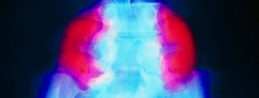 Stem cell patch reverses brain damage in fetuses with spina bifida Stem cell patch reverses brain damage in fetuses with spina bifida