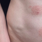 A STI Fungus Is Making Itself Cozy in the US A STI Fungus Is Making Itself Cozy in the US