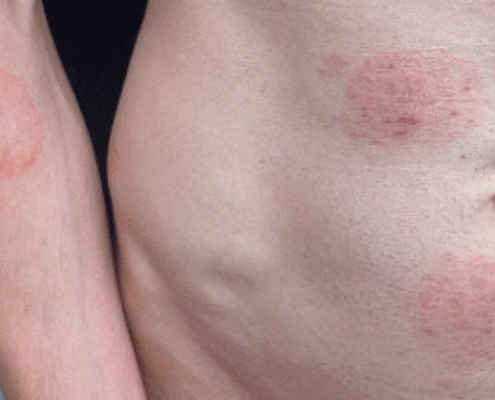 A STI Fungus Is Making Itself Cozy in the US A STI Fungus Is Making Itself Cozy in the US