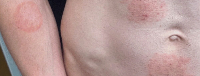 A STI Fungus Is Making Itself Cozy in the US