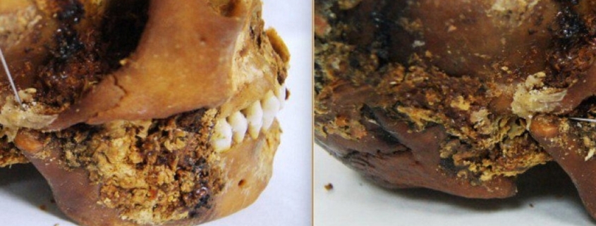 Iron Age Surgeons Fixed a Woman’s Shattered Jaw With Primitive Prosthetic—and She Survived