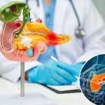 Pancreatic cancer breakthrough: tumors disappear in mice