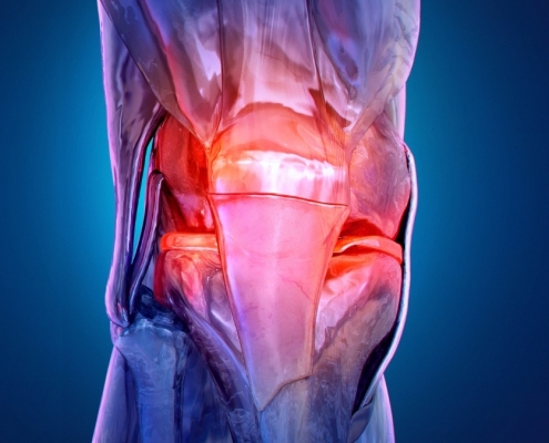 Osteoarthritis Is Appearing in Younger Adults, Triggering Decades of Discomfort : ScienceAlert