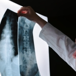 RCSI experts develop 3D implant that stimulates spinal cord healing