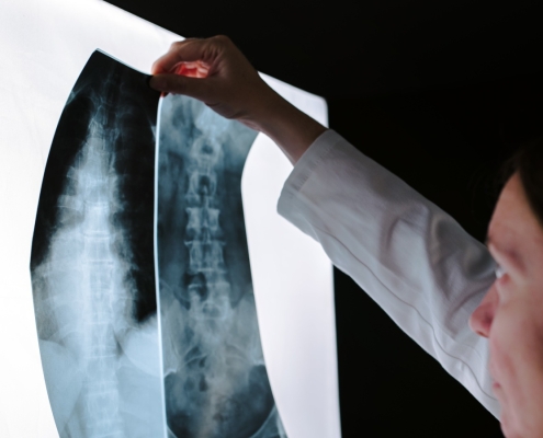 RCSI experts develop 3D implant that stimulates spinal cord healing RCSI experts develop 3D implant that stimulates spinal cord healing