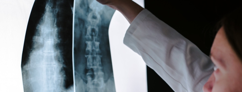 RCSI experts develop 3D implant that stimulates spinal cord healing