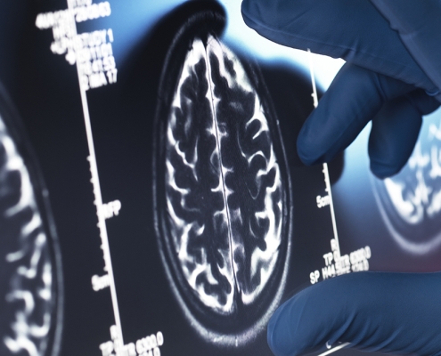 Viagra May Be One of Our Best Existing Options For an Alzheimer’s Treatment : ScienceAlert