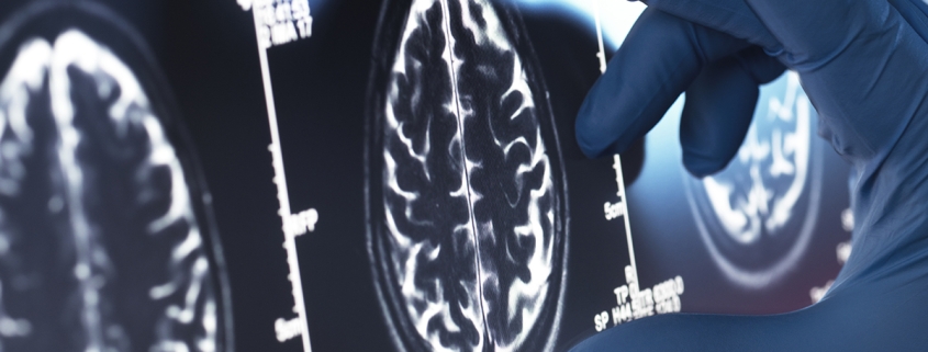 Viagra May Be One of Our Best Existing Options For an Alzheimer’s Treatment : ScienceAlert Viagra May Be One of Our Best Existing Options For an Alzheimer’s Treatment : ScienceAlert