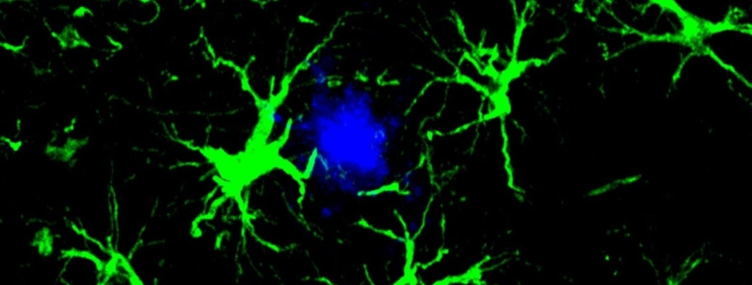 These Genetically Engineered Brain Cells Devour Toxic Alzheimer’s Plaques