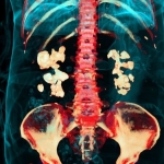 Bacteria Play Previously Unknown Role in Kidney Stones, Study Finds : ScienceAlert