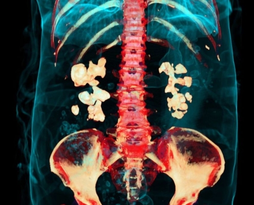 Bacteria Play Previously Unknown Role in Kidney Stones, Study Finds : ScienceAlert