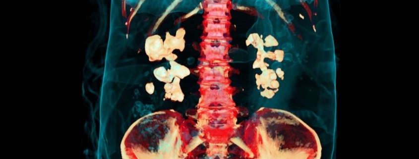 Bacteria Play Previously Unknown Role in Kidney Stones, Study Finds : ScienceAlert