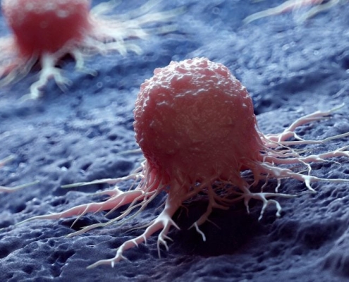 Scientists Uncover Hidden Cancer Risk in Common Bowel Growths