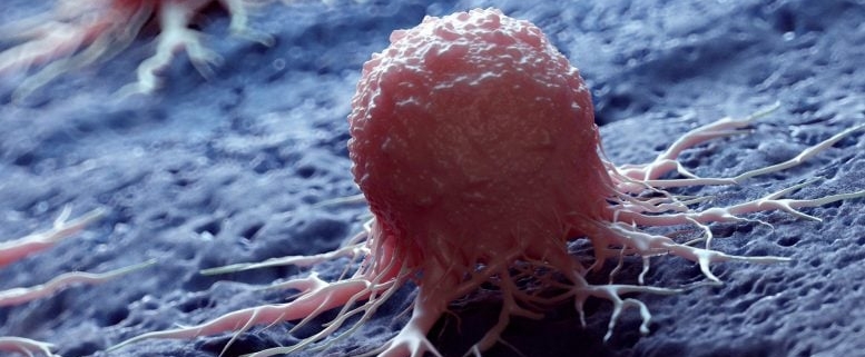 Scientists Uncover Hidden Cancer Risk in Common Bowel Growths