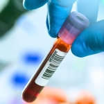 Blood Tests Could Revolutionize Early Cancer Detection – But There’s a Catch : ScienceAlert