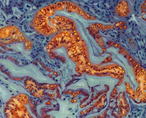 Breakthrough Discovery Could Make Pancreatic Cancer Respond to Chemo Again