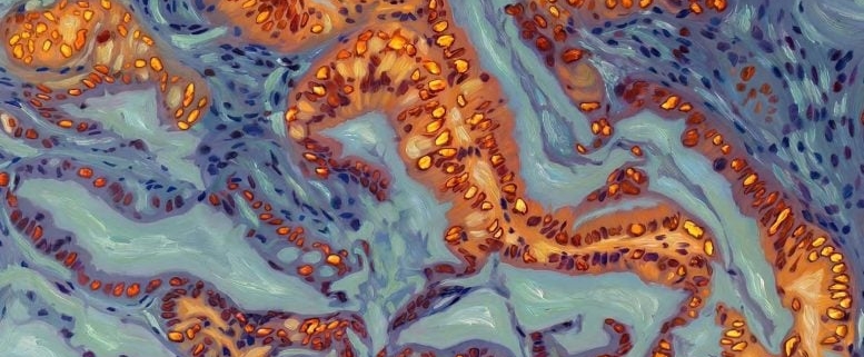 Breakthrough Discovery Could Make Pancreatic Cancer Respond to Chemo Again