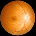 What Is ‘Eye Stroke’? Expert Explains The Rare Wegovy Risk : ScienceAlert