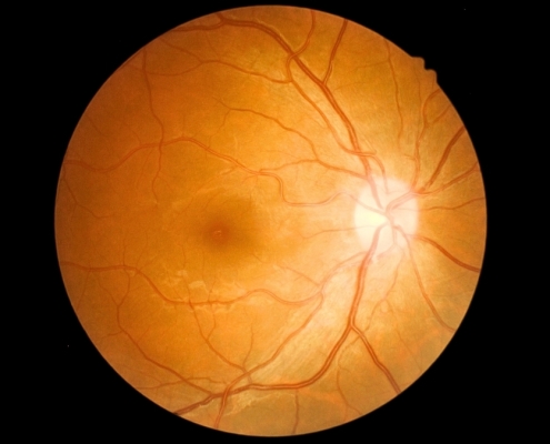 What Is ‘Eye Stroke’? Expert Explains The Rare Wegovy Risk : ScienceAlert What Is ‘Eye Stroke’? Expert Explains The Rare Wegovy Risk : ScienceAlert