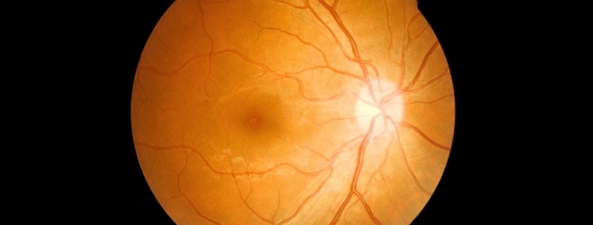 What Is ‘Eye Stroke’? Expert Explains The Rare Wegovy Risk : ScienceAlert