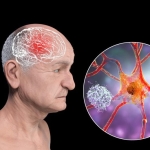 FDA-Approved Seizure Drug May Stop Alzheimer’s Before It Starts