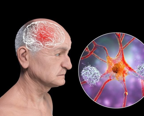 FDA-Approved Seizure Drug May Stop Alzheimer’s Before It Starts