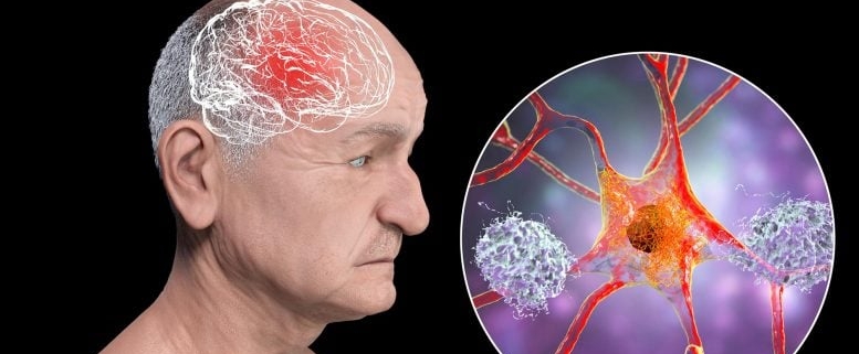 FDA-Approved Seizure Drug May Stop Alzheimer’s Before It Starts