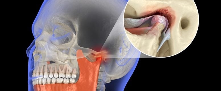 New Enzyme Discovery Could Protect Jaw Cartilage and Stop Arthritis
