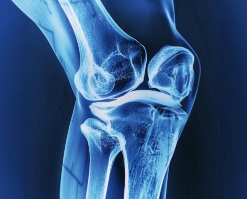 This Jelly-Like Implant Could Help Broken Bones Heal Themselves