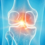 Semaglutide May Reverse Damage Caused by Osteoarthritis, Study Suggests : ScienceAlert