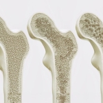 Bone-Strengthening Discovery Could Reverse Osteoporosis