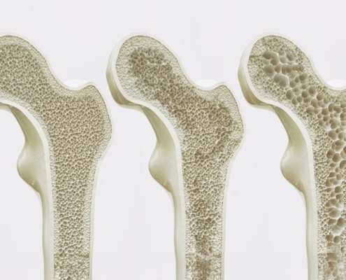 Bone-Strengthening Discovery Could Reverse Osteoporosis