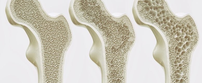Bone-Strengthening Discovery Could Reverse Osteoporosis