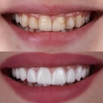 The Crown Jewel of Dentistry? Breakthrough Tech Could Transform Tooth Repair